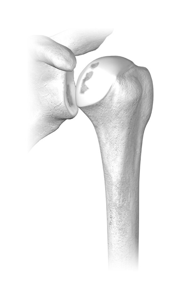Osteoarthritic shoulder with clearly visible cartilage damage