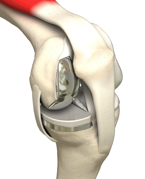 Knee with unicondylar knee replacement