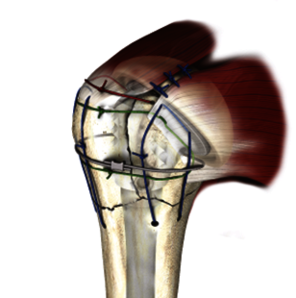 Shoulder treated with fracture prosthesis