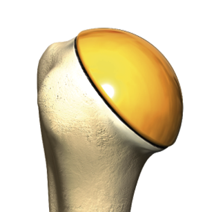 The artificial head replaces the natural humeral head