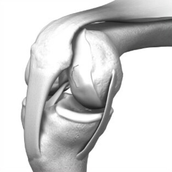 Knee joint with defective cartilage