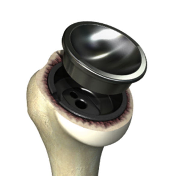 …whereas the artificial socket is placed onto the stem in the upper arm bone 