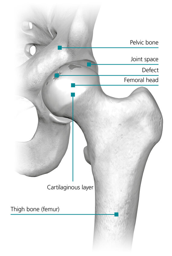 Osteoarthritic hip with clearly visible cartilage damage