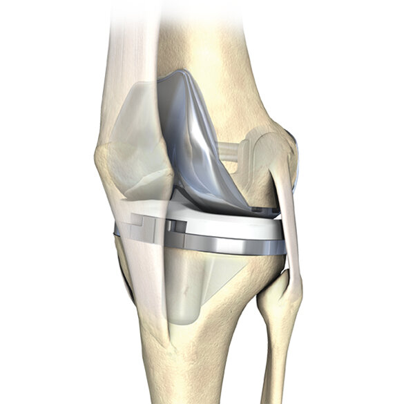 Knee with total knee joint replacement