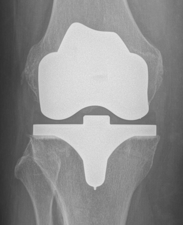 X-ray after successful operation