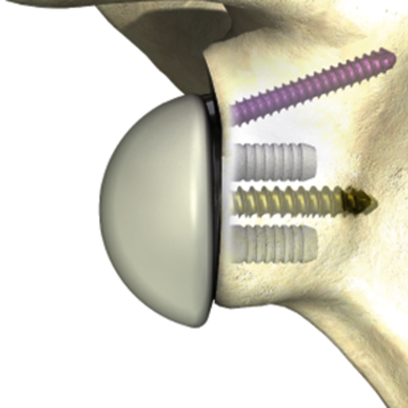 The head is anchored in the shoulder socket…